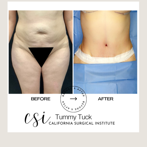 tummytuck upland California