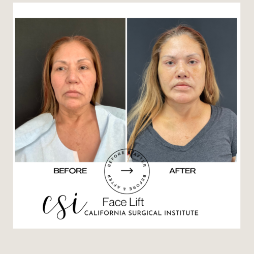 Face Lift Before & After