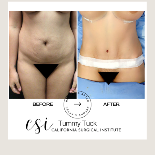 Tummy Tuck Beverly Hills