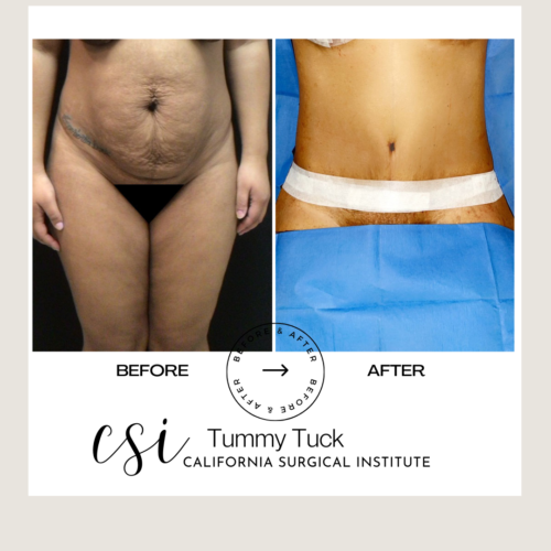 Tummy Tuck Beverly Hills