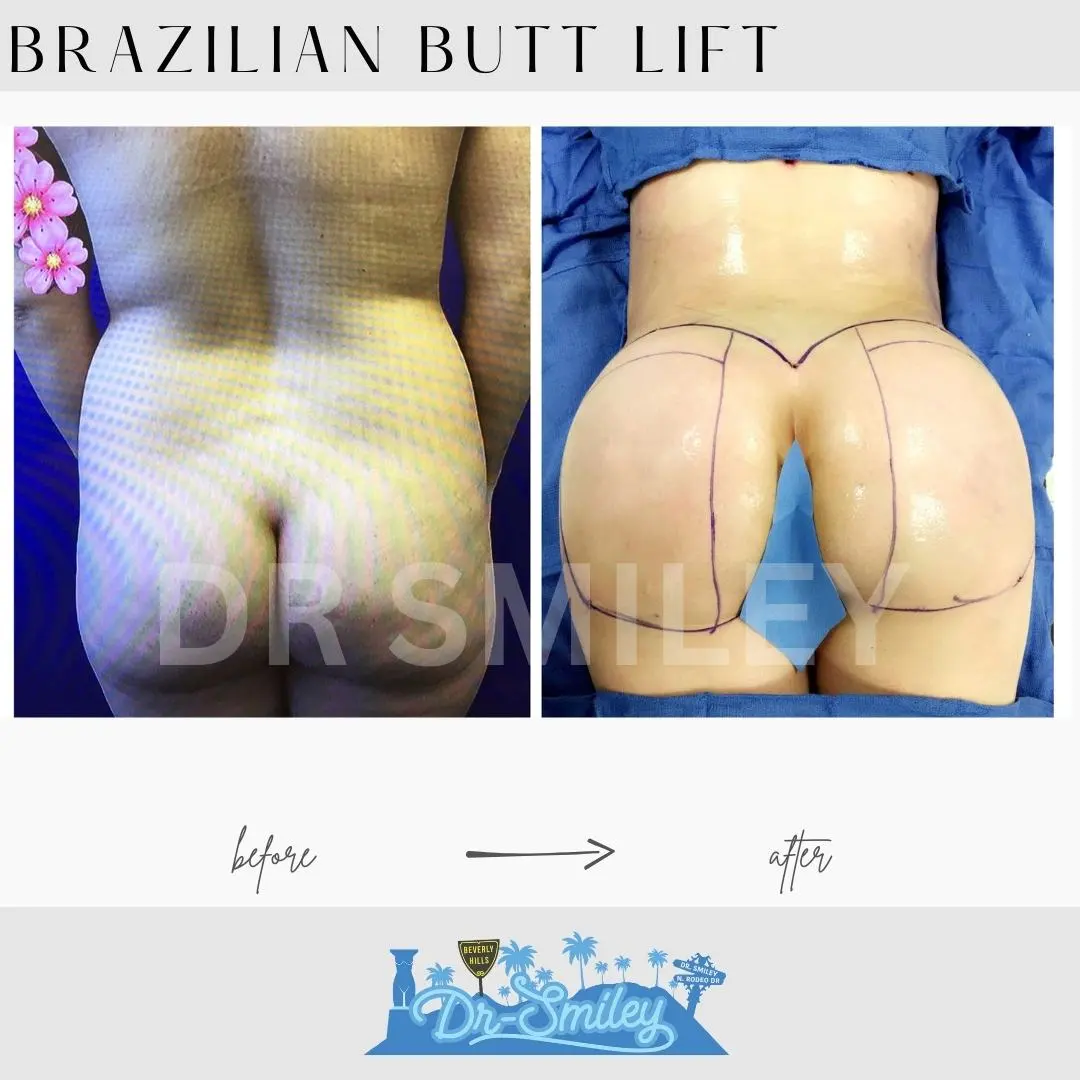 bbl surgery beverly hills before and after