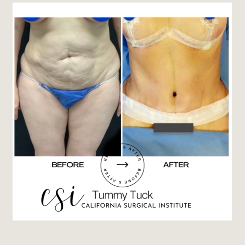 Tummy Tuck Beverly Hills