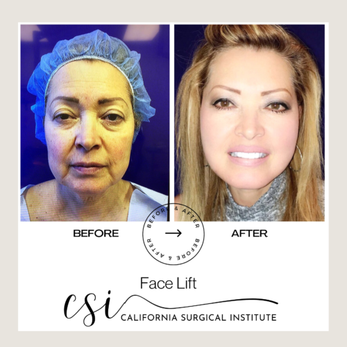 Face Lift Before & After