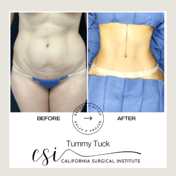 Tummy Tuck Before After