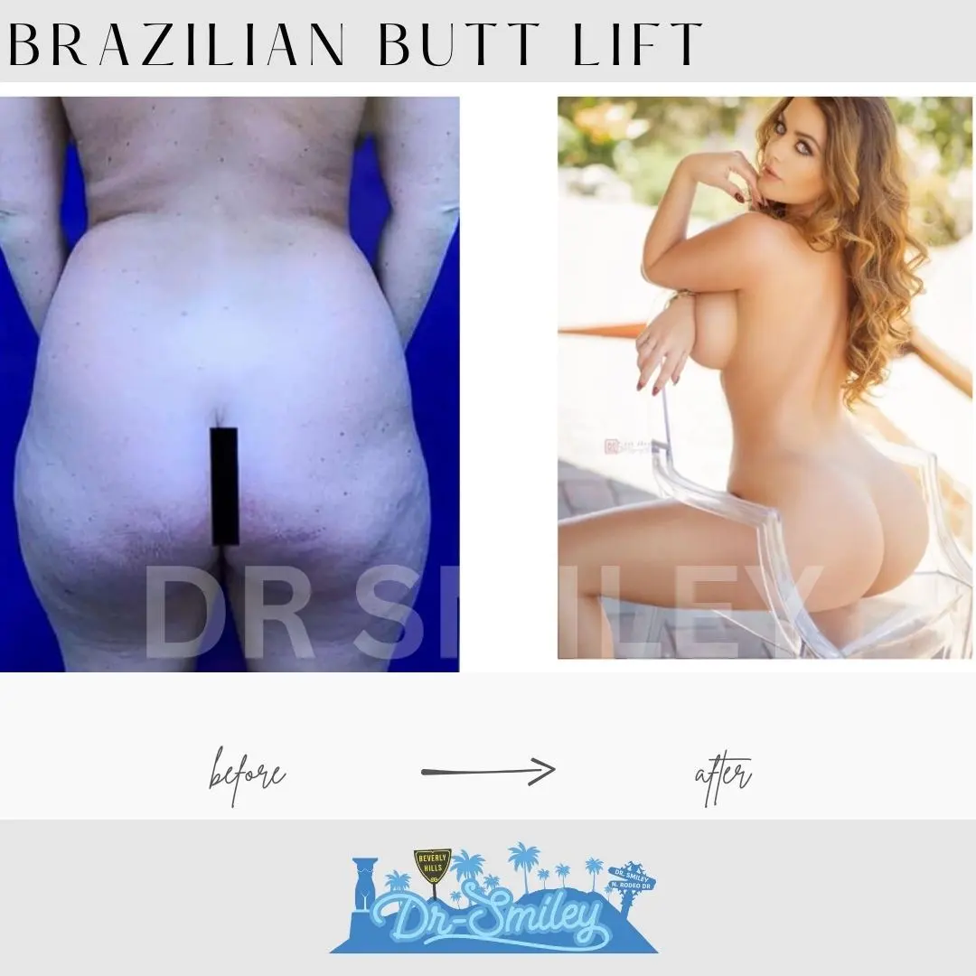 brazilian butt lift before after beverly hills