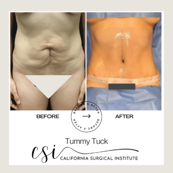 Tummy Tuck before after