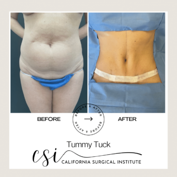 Tummy Tuck before after