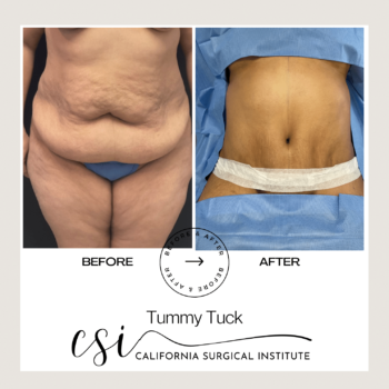 AFTER BEFORE TUMMY TUCK SURGERY