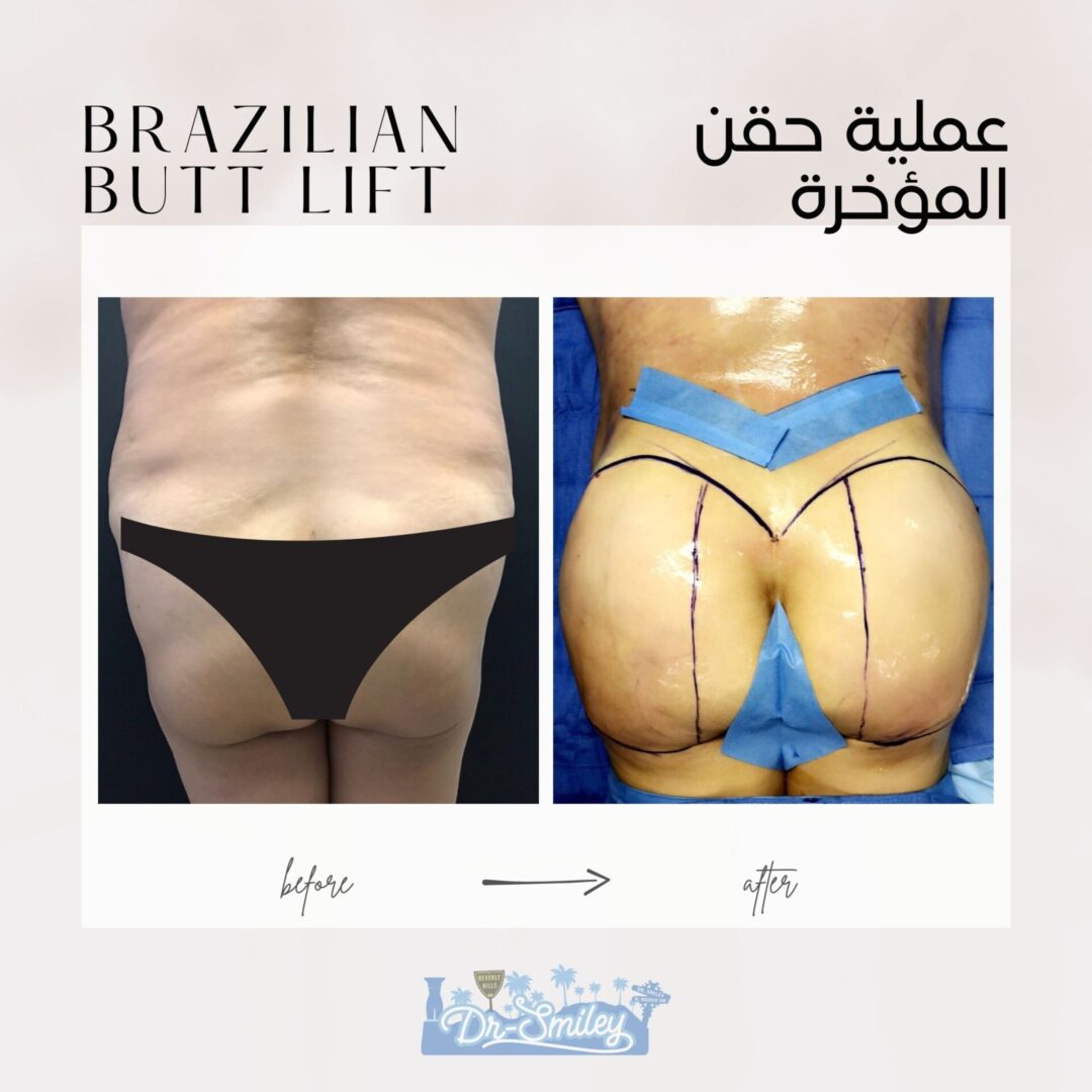 brazilian but lift surgery in beverly hills before and after