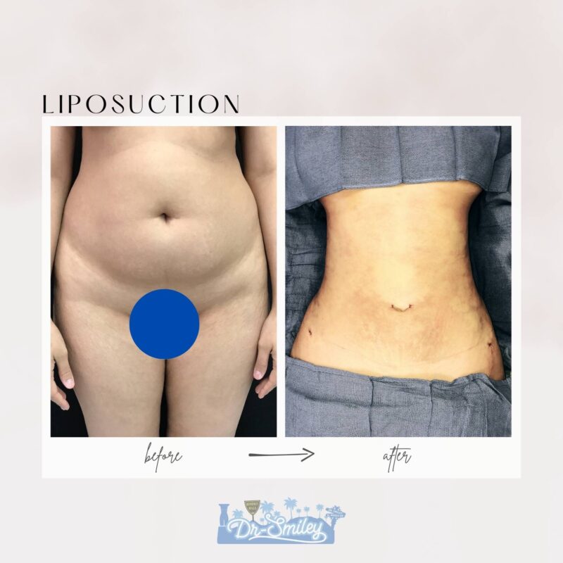 dr smiley top plastic surgeon bbl beverly hills california liposuction1