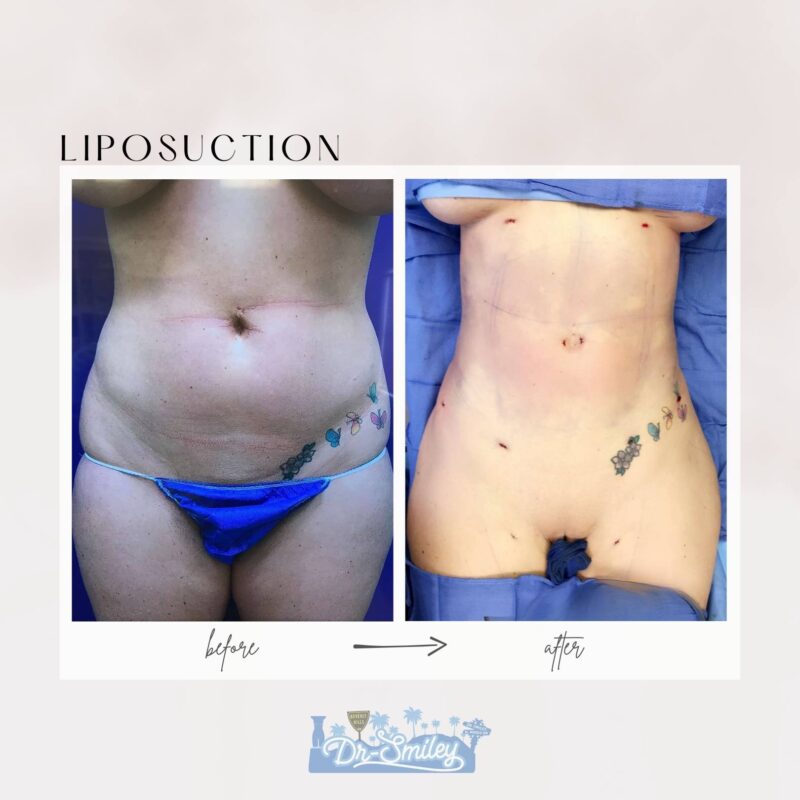 dr smiley top plastic surgeon bbl beverly hills california liposuction2