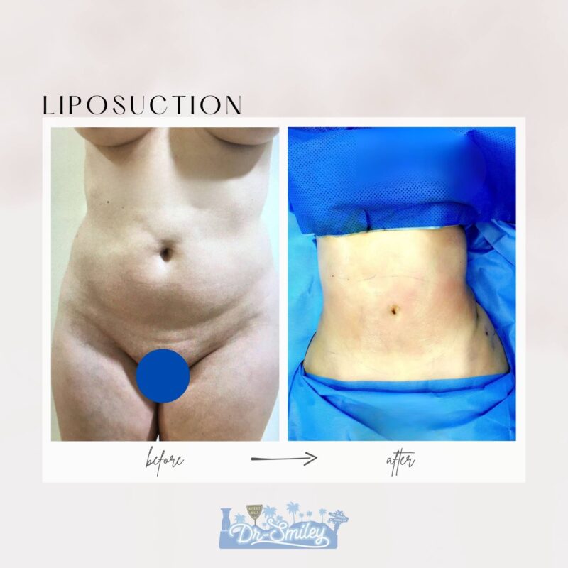 dr smiley top plastic surgeon bbl beverly hills california liposuction3