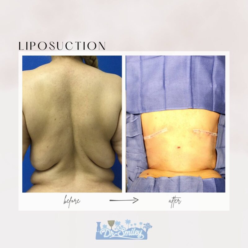 liposuction beverly hills california