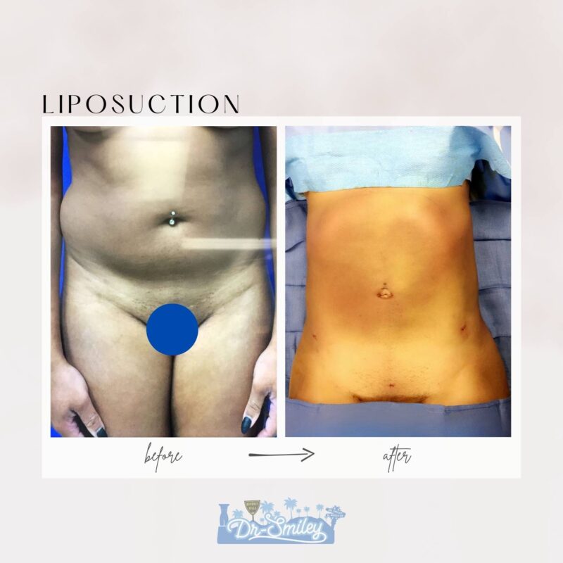 liposuction beverly hills california