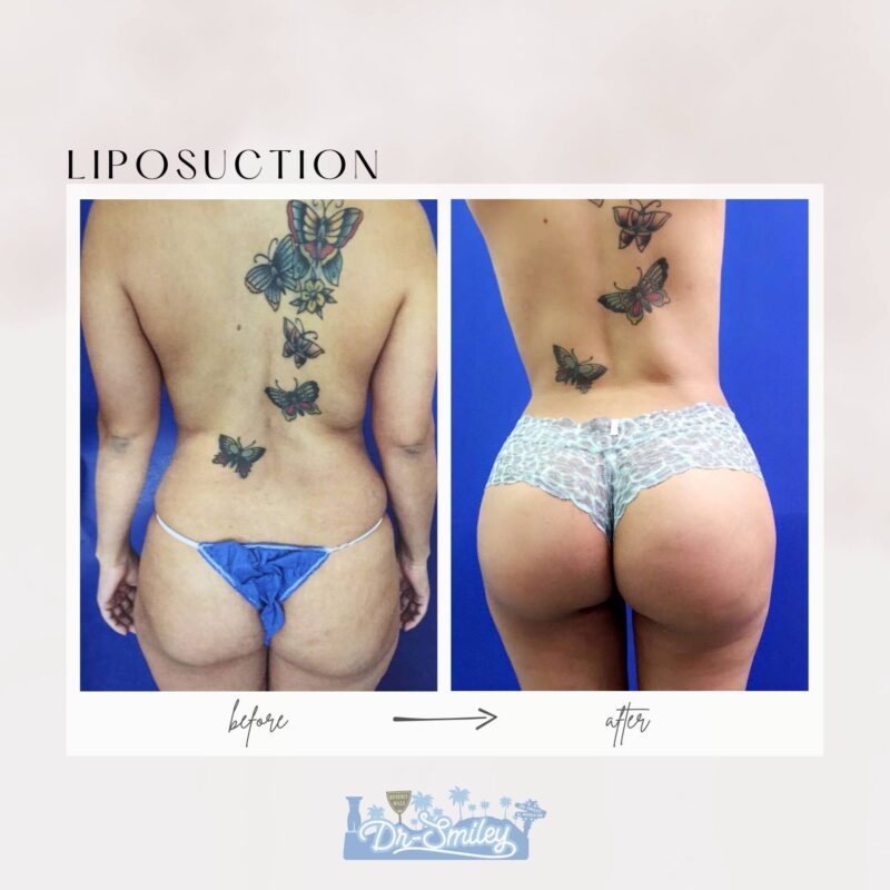 liposuction beverly hills