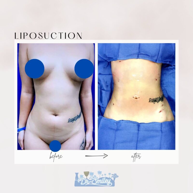 liposuction beverly hills before and after