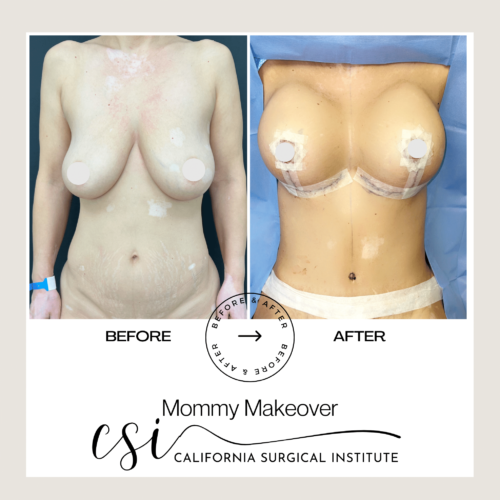 mommy makeover upland California