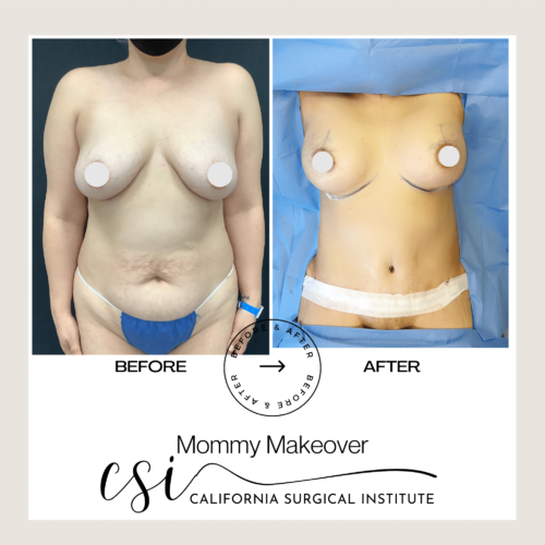 mommy makeover beverly hills California