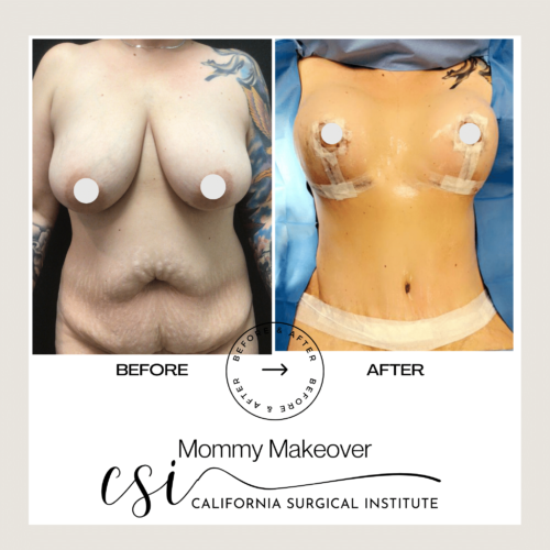 mommy makeover beverly hills California