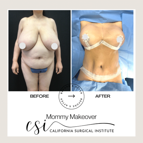 mommy makeover beverly hills California