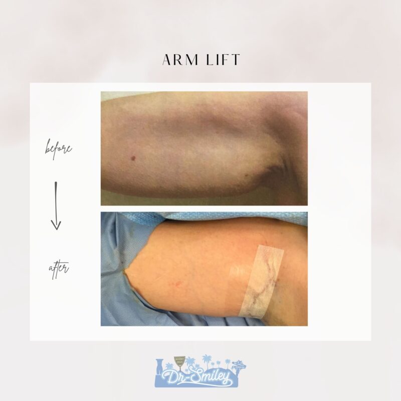 armlift surgery in beverly hills before and after images