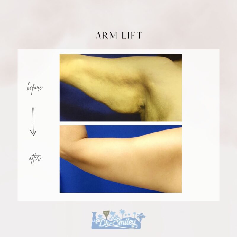 armlift surgery in beverly hills before and after images