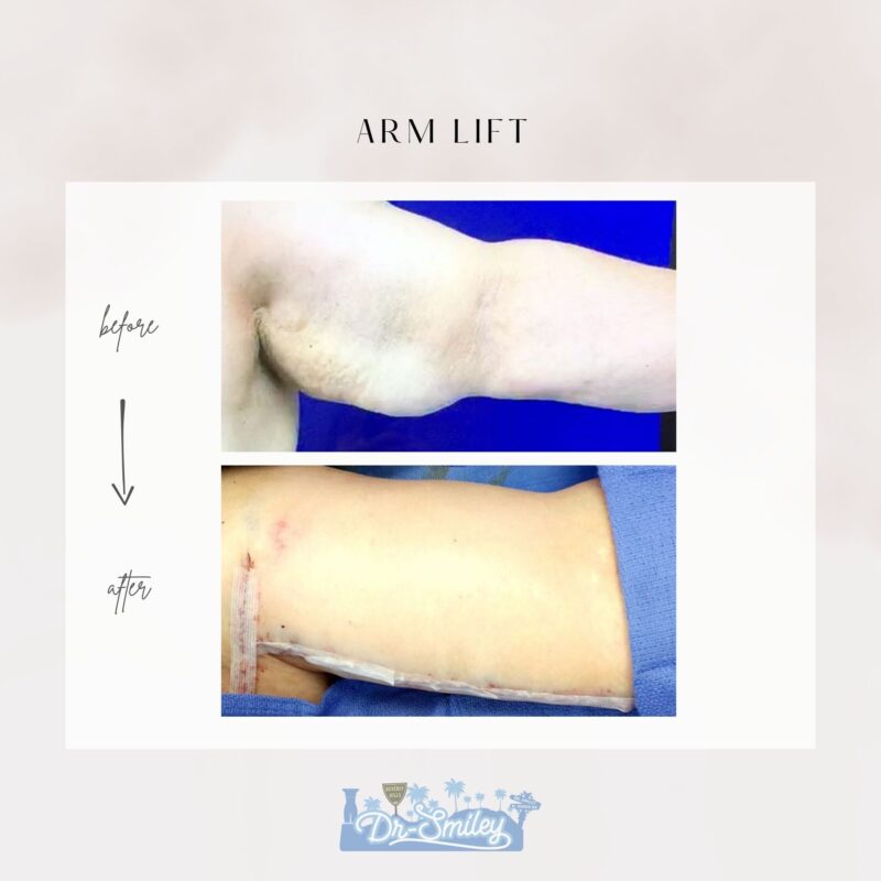 armlift surgery in beverly hills before and after images