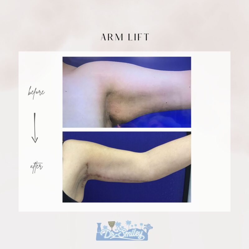 armlift surgery in beverly hills before and after images