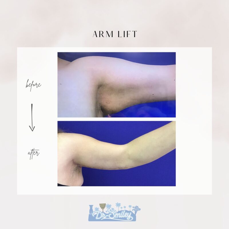 armlift surgery in beverly hills before and after images