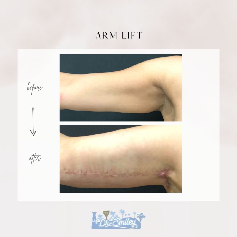 armlift surgery in beverly hills before and after images