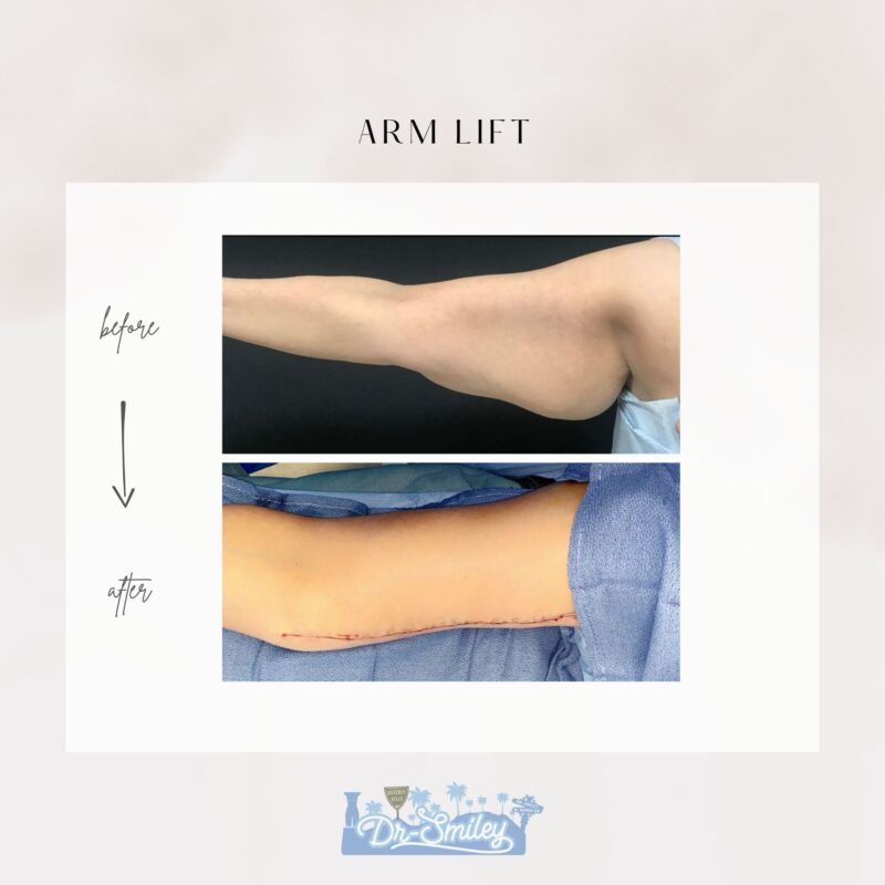 armlift surgery in beverly hills before and after images