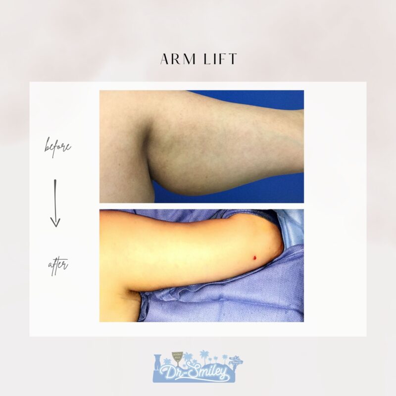 armlift surgery in beverly hills before and after images