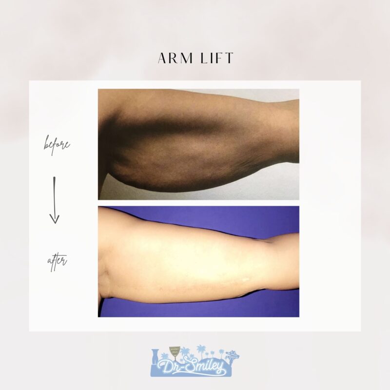 armlift surgery in beverly hills before and after images