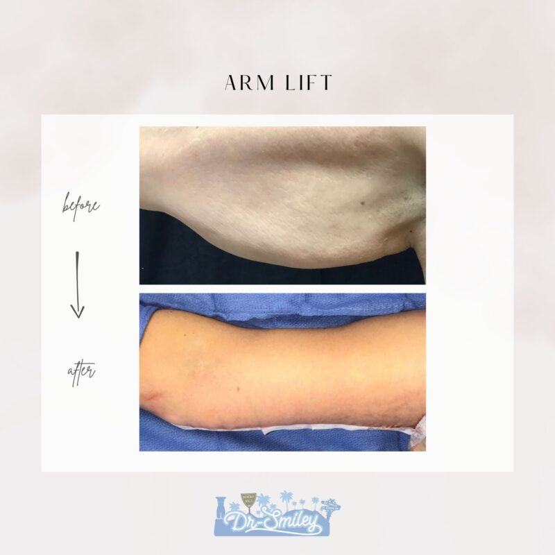 armlift surgery in beverly hills before and after images