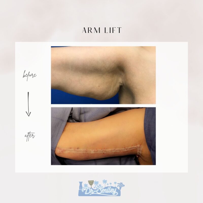 armlift surgery in beverly hills before and after images