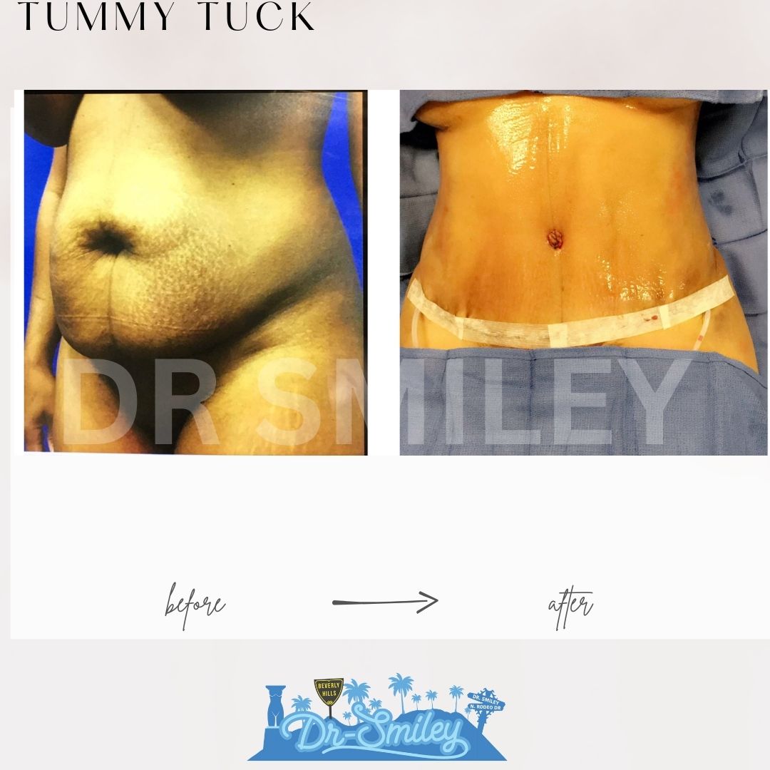 tummy tuck before and after photos beverly hills, ca