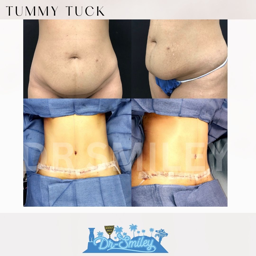 tummy tuck before and after photos beverly hills, ca