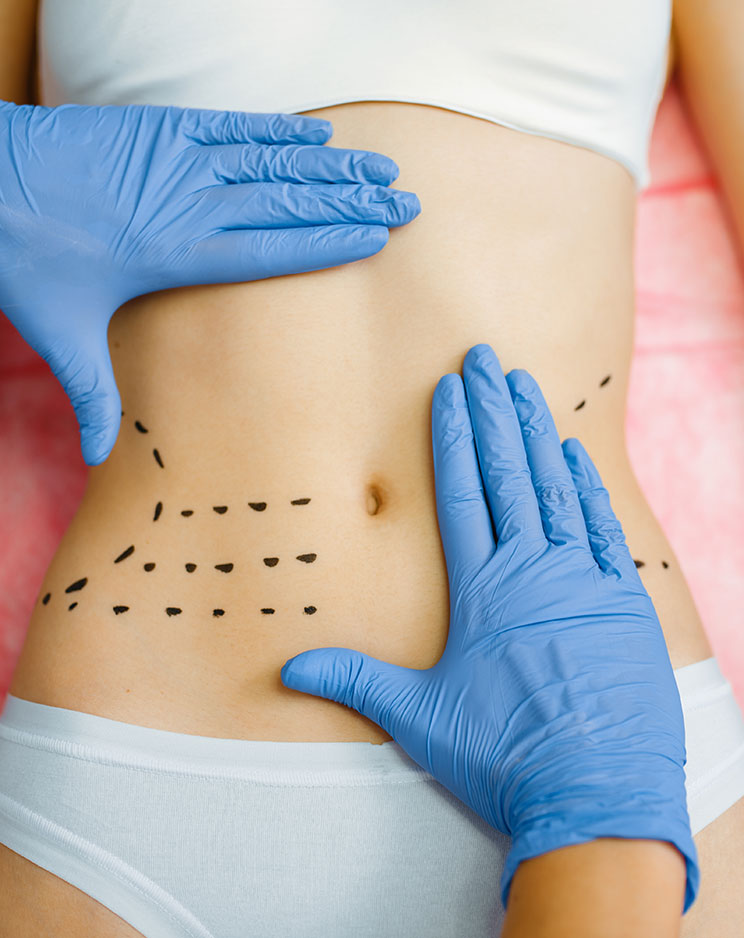 tummy tuck surgery in beverly hills