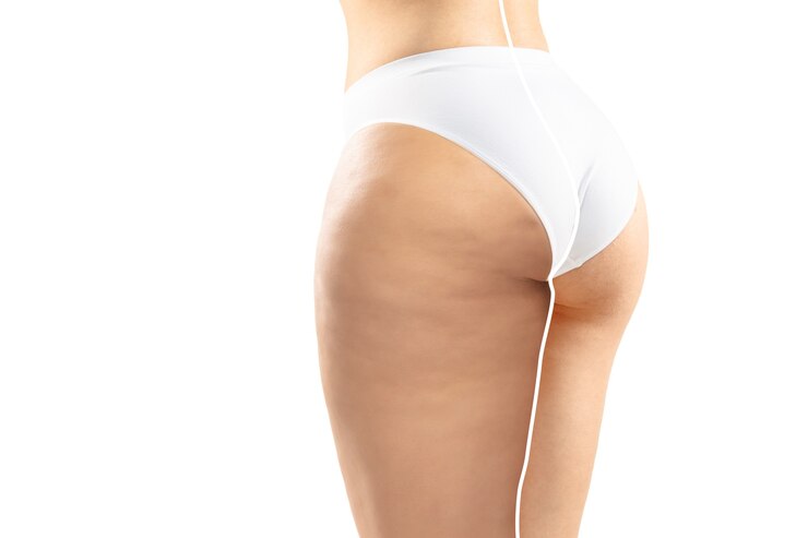 Scars From Buttock Augmentation