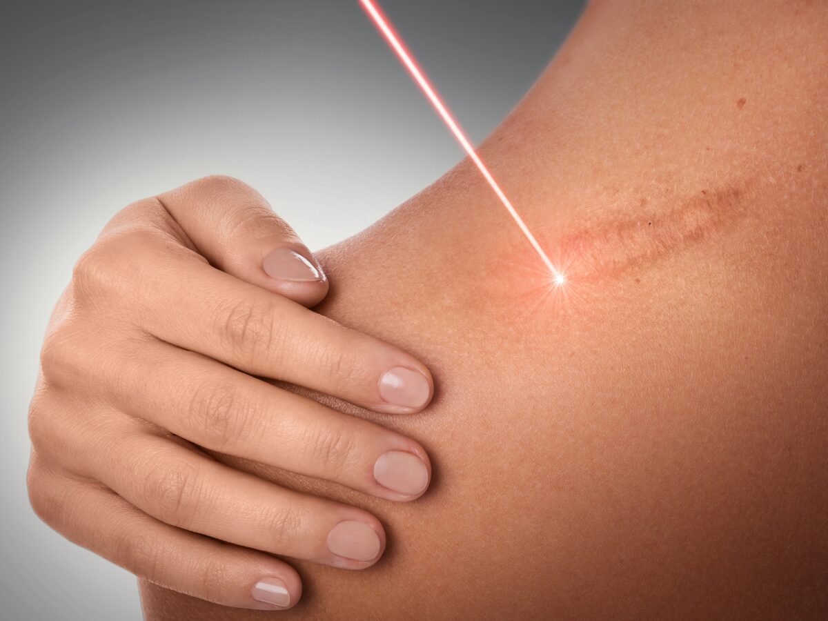 Innovations in Scar Revision Techniques: Advances in Wound Healing and Aesthetics