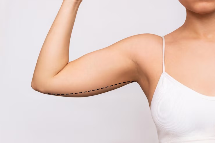 Arm Liposuction In Beverly Hills – Insights From The Expert