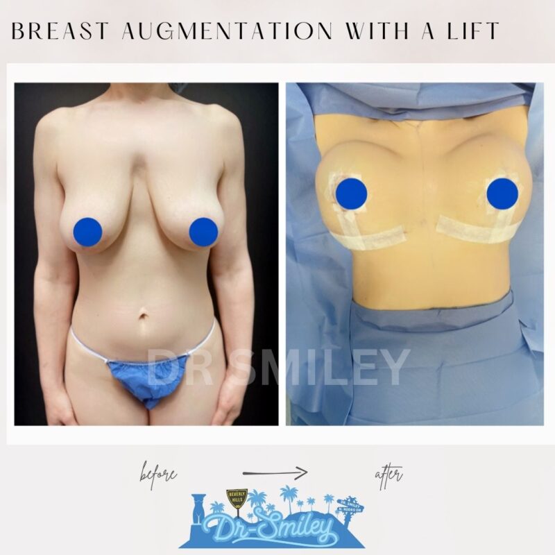 dr smiley top plastic surgeon breast augmentation with lift beverly hills los angeles california 1