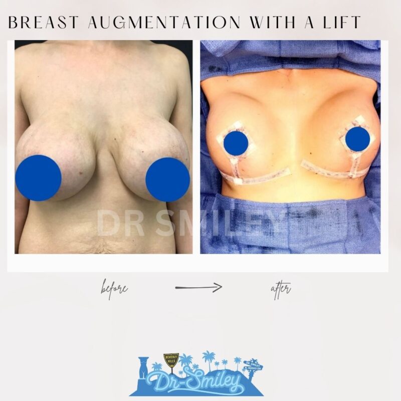 dr smiley top plastic surgeon breast augmentation with lift beverly hills los angeles california 15