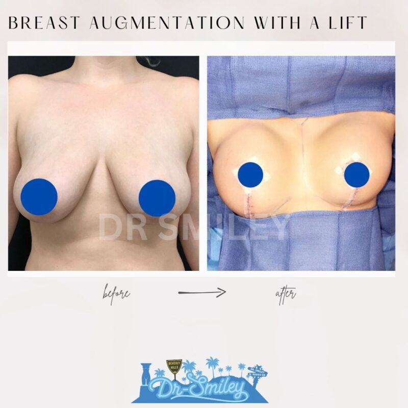 dr smiley top plastic surgeon breast augmentation with lift beverly hills los angeles california 16