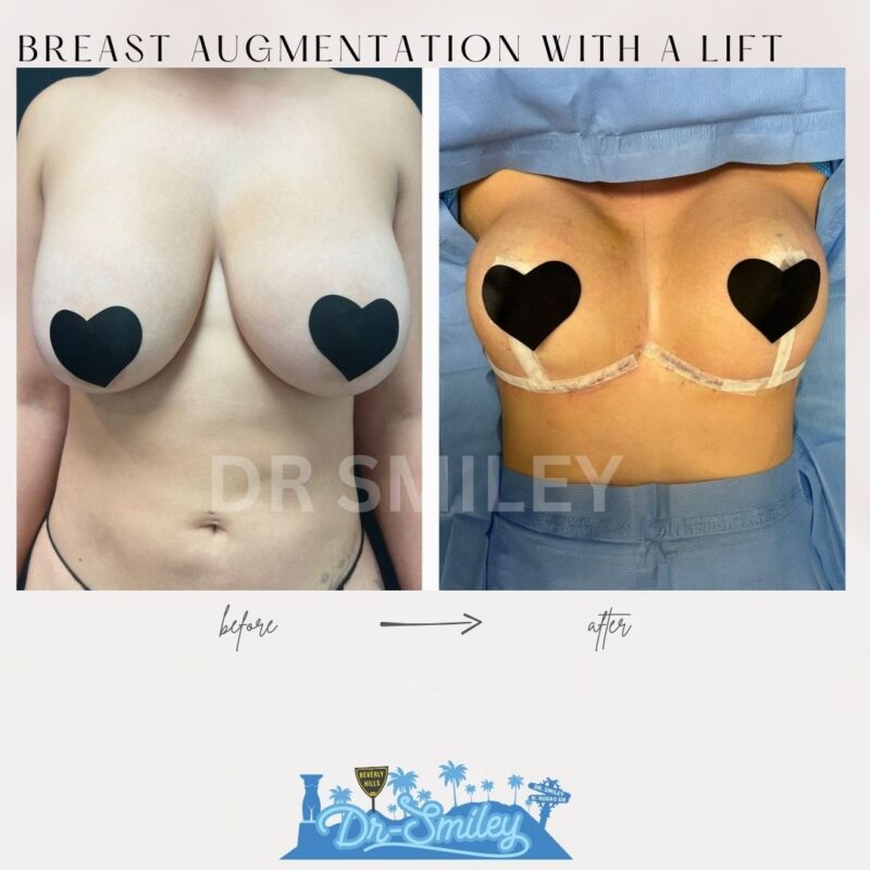 dr smiley top plastic surgeon breast augmentation with lift beverly hills los angeles california 17