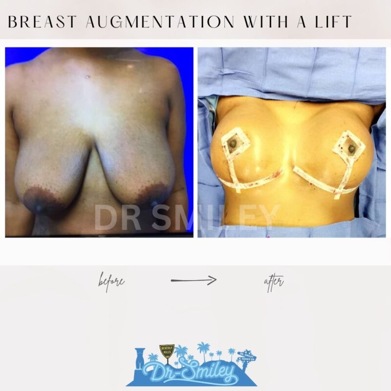 dr smiley top plastic surgeon breast augmentation with lift beverly hills los angeles california 18