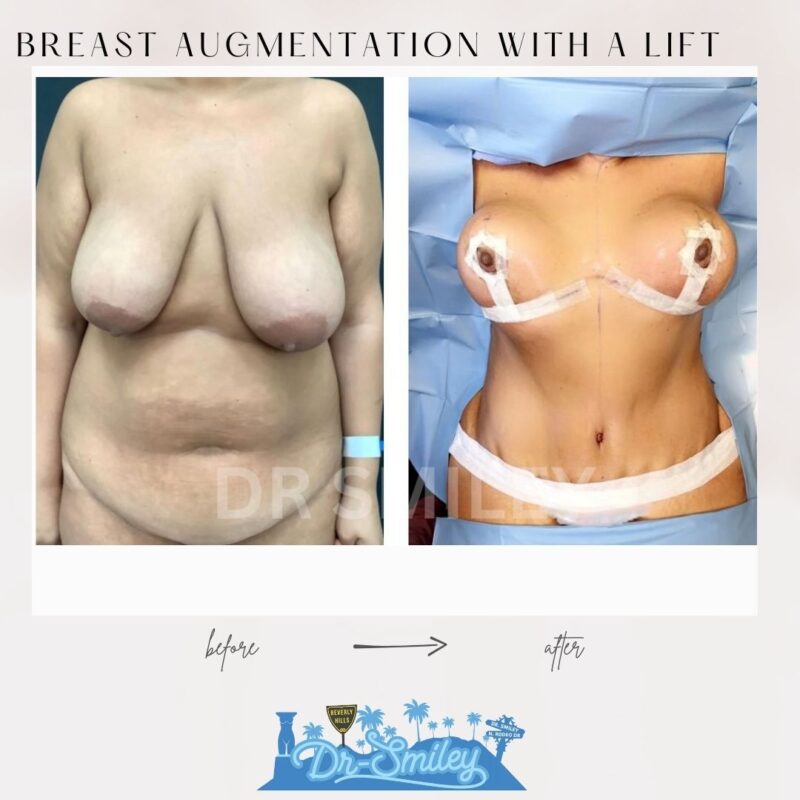 dr smiley top plastic surgeon breast augmentation with lift beverly hills los angeles california 2