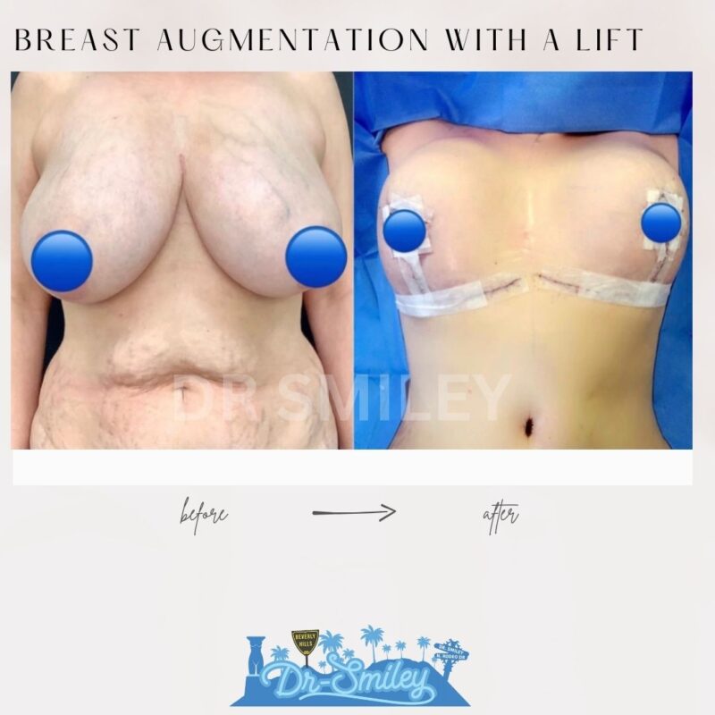 dr smiley top plastic surgeon breast augmentation with lift beverly hills los angeles california 20