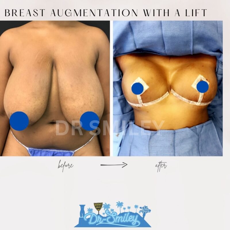 dr smiley top plastic surgeon breast augmentation with lift beverly hills los angeles california 21