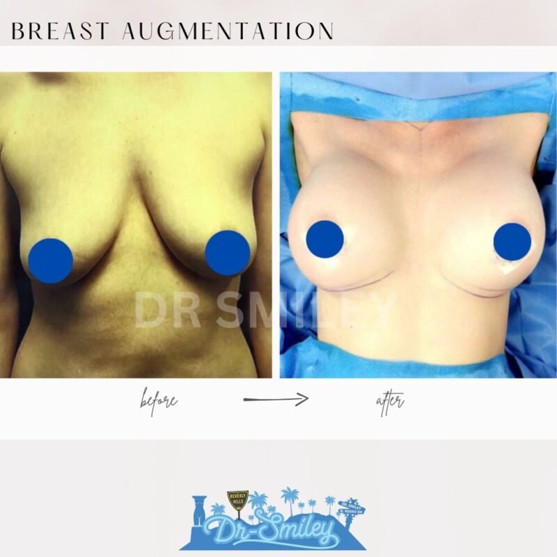 dr smiley top plastic surgeon breast augmentation with lift beverly hills los angeles california 22